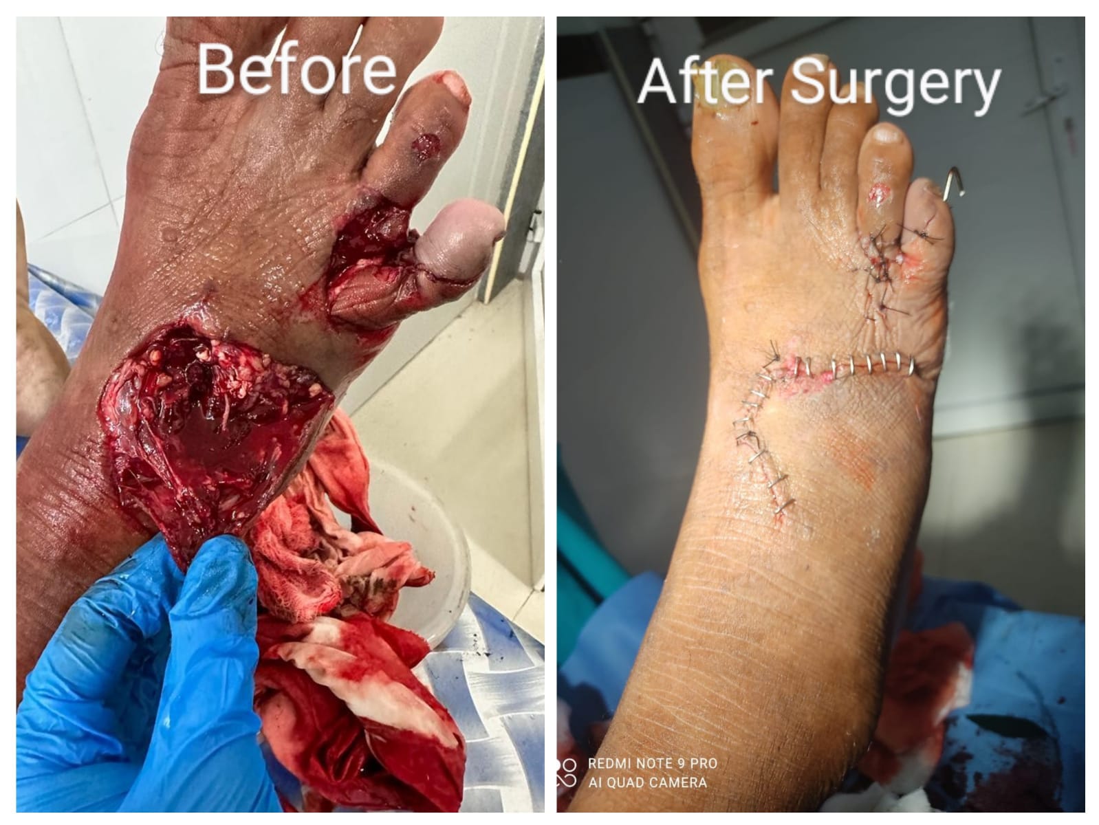 LIMB RECONSTRUCTION