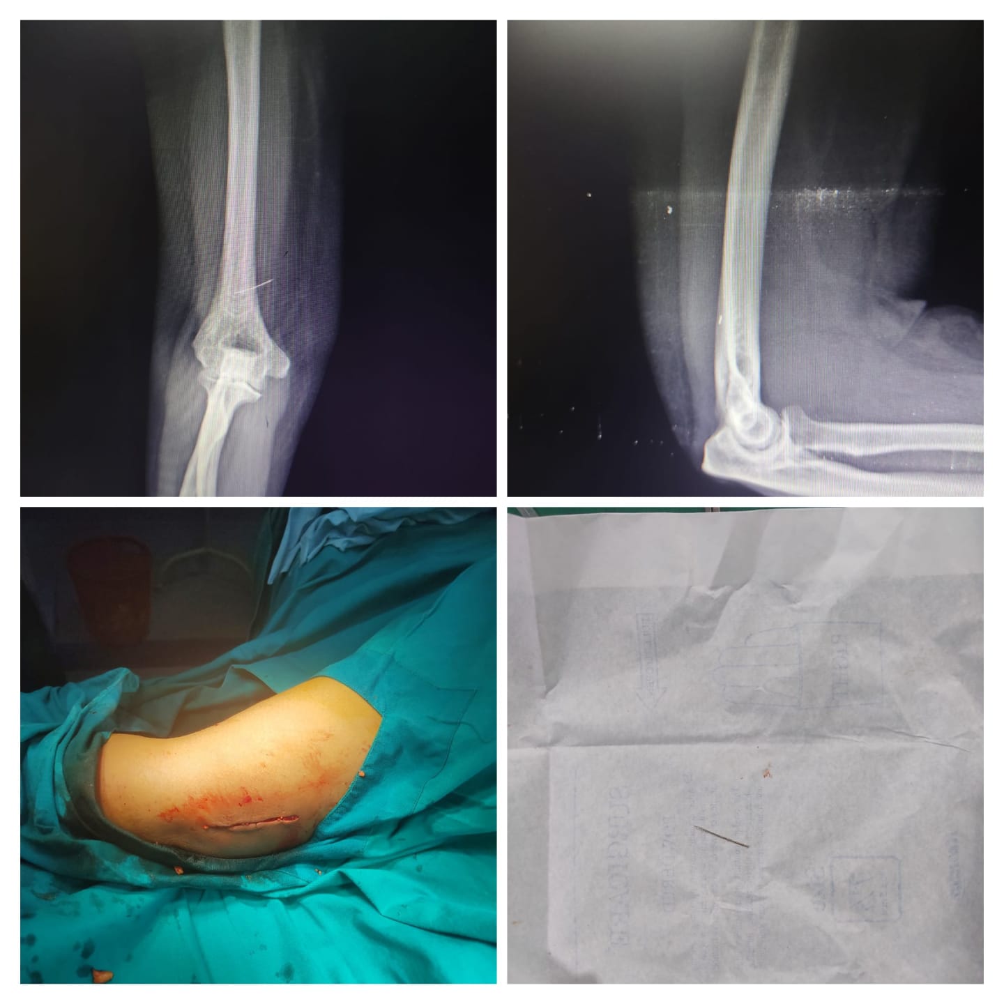 Removal of the pin done under LA