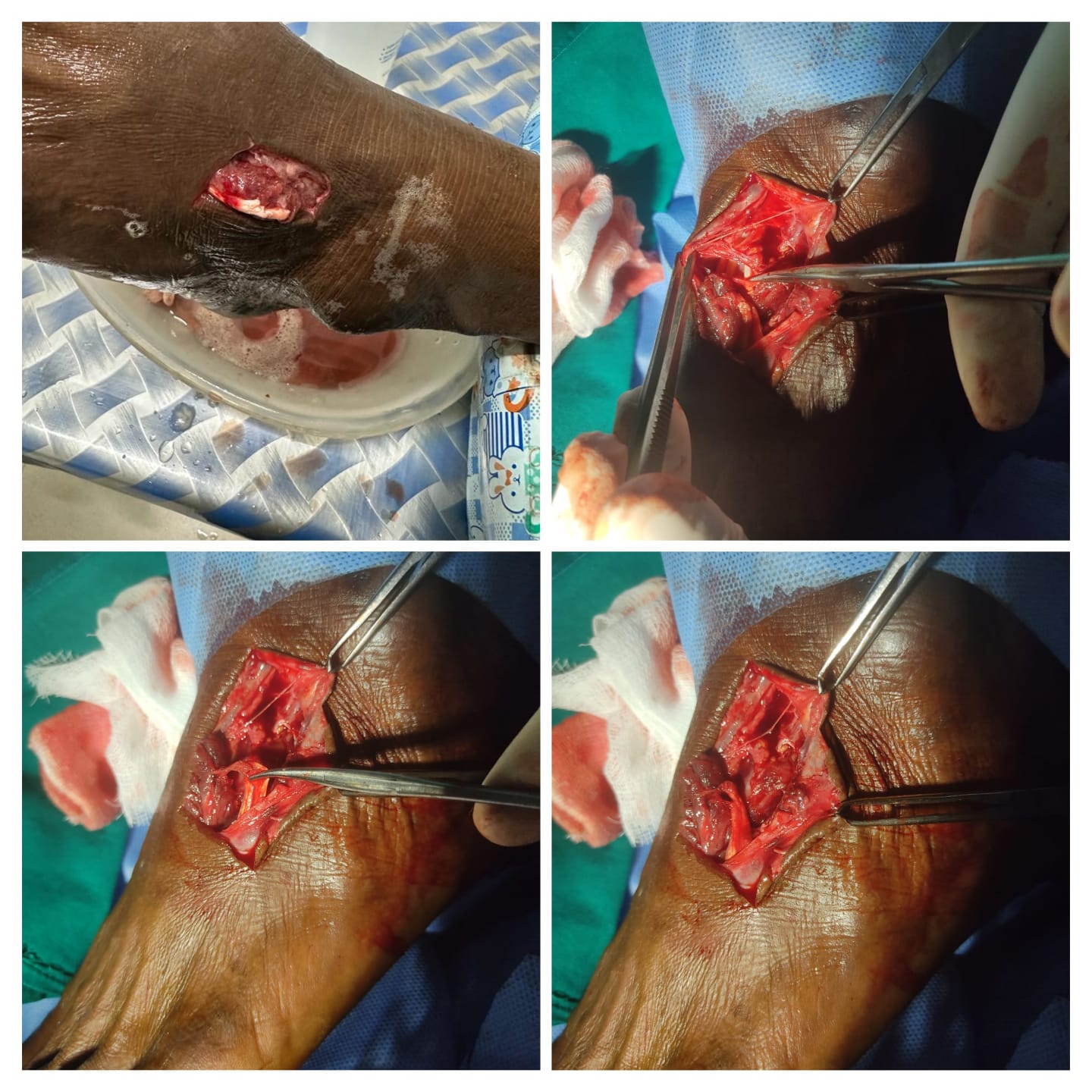 Tendon repair done under LA