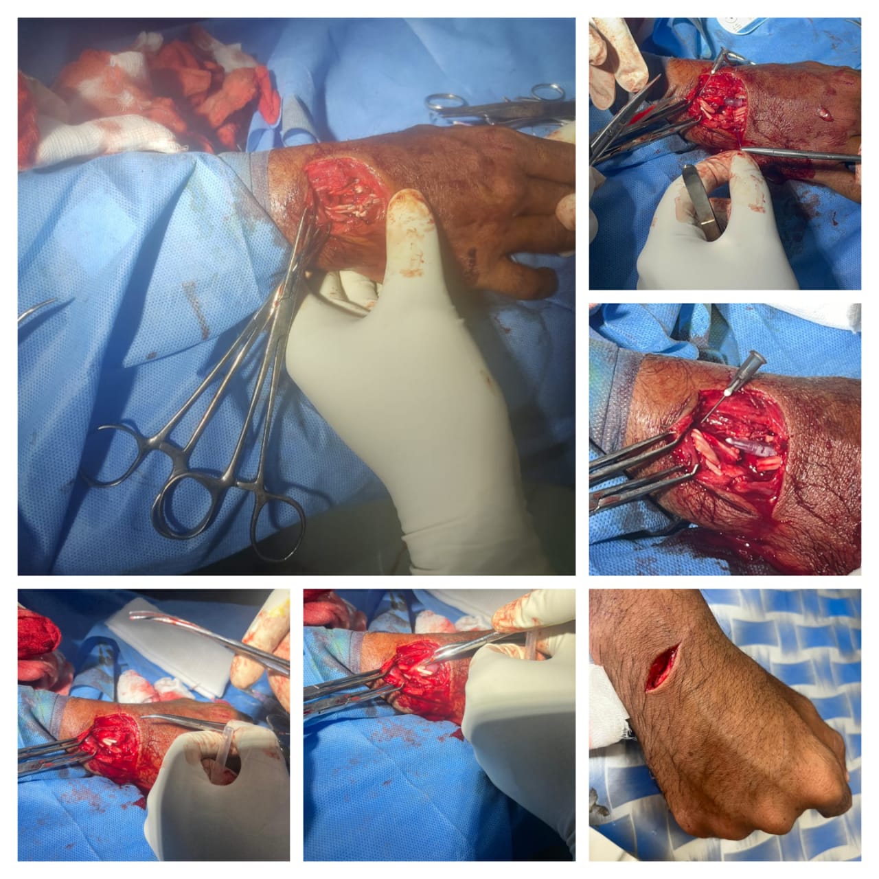 Tendon repair