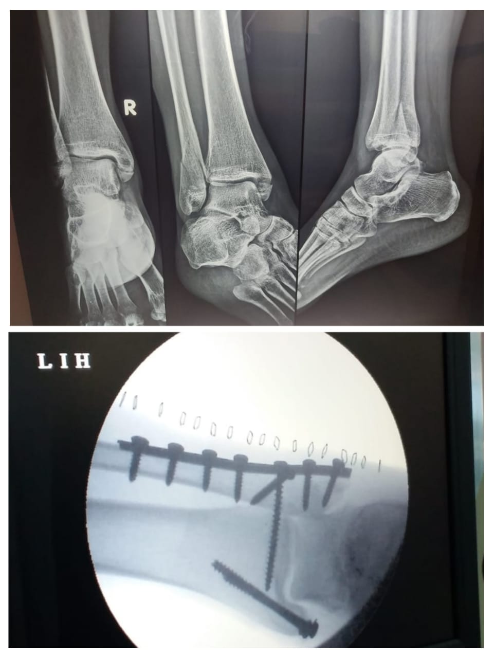 Bimalleolar fracture